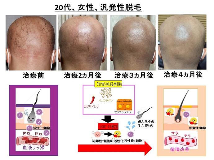 円形脱毛症　病院